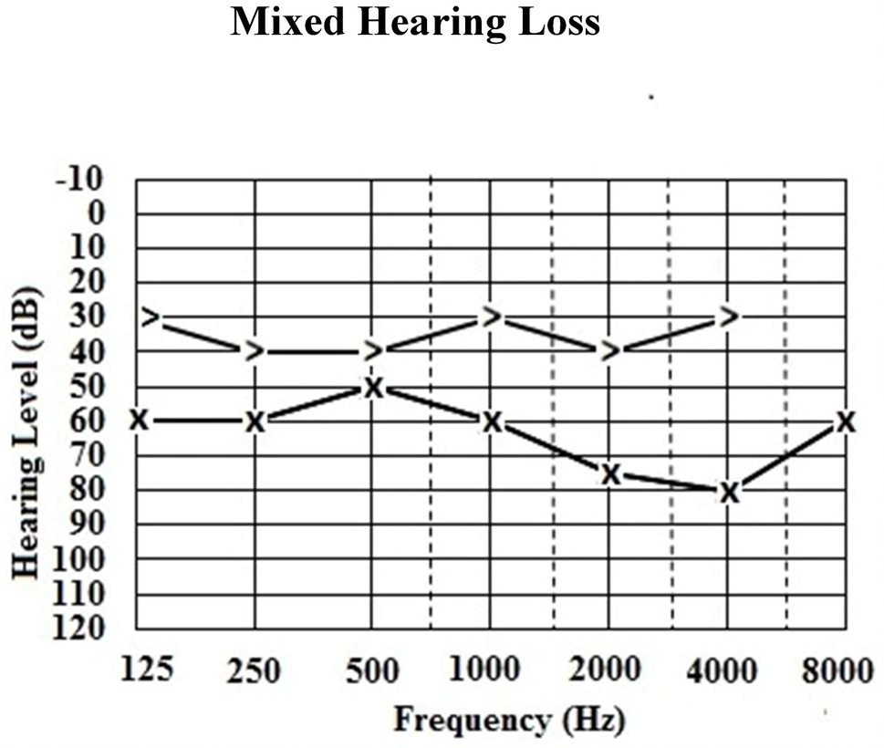 Audiometry Explained (audiometry hearing test) — y hearing test explained illustration