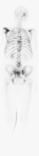 Bone Scan (Nuclear Medicine) Explained (bone scan nuclear medicine) — clear medicine explained illustration