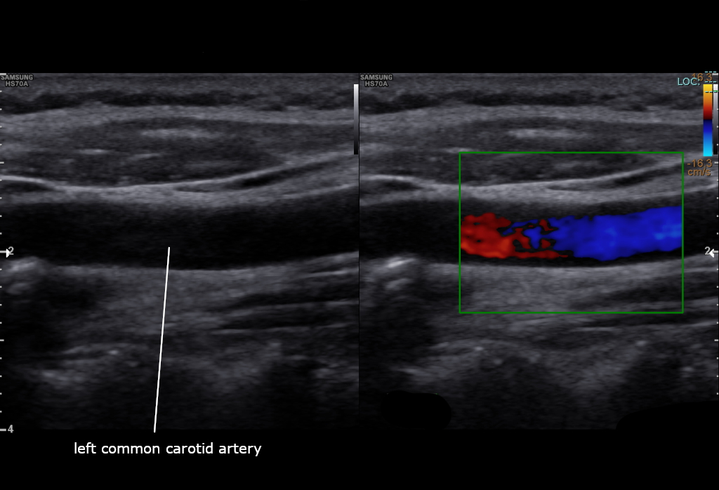 Carotid Doppler Ultrasound Explained (carotid doppler ultrasound) — nd stroke risk explained illustration
