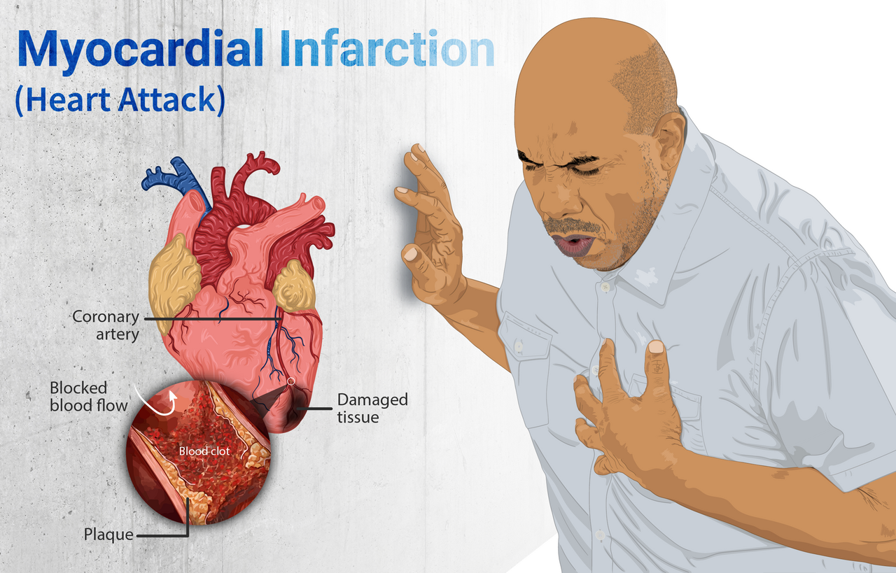 Chest Pain After Eating vs Heart Attack (chest pain after eating vs heart attack) — r eating vs heart attack illustration