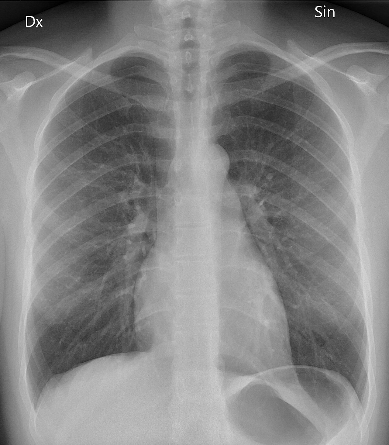 Chest X-ray Explained (chest x ray explained) — lained when you need one illustration