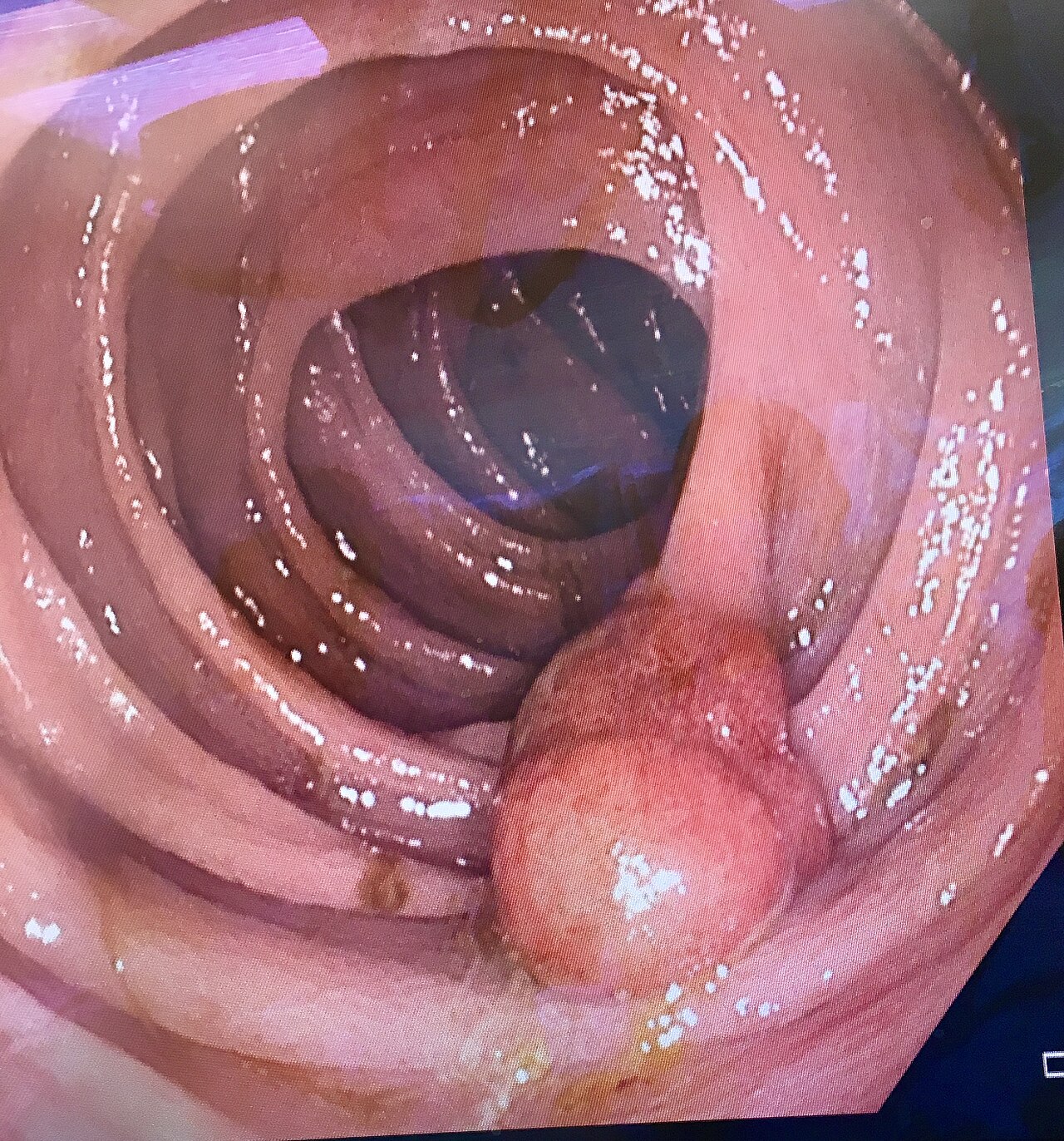 Colonoscopy Explained (colonoscopy explained) — ening polyps preparation illustration