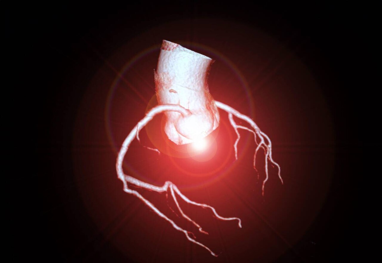 Coronary Artery Calcium Score (CAC) Explained (coronary calcium score) — cium score cac explained illustration