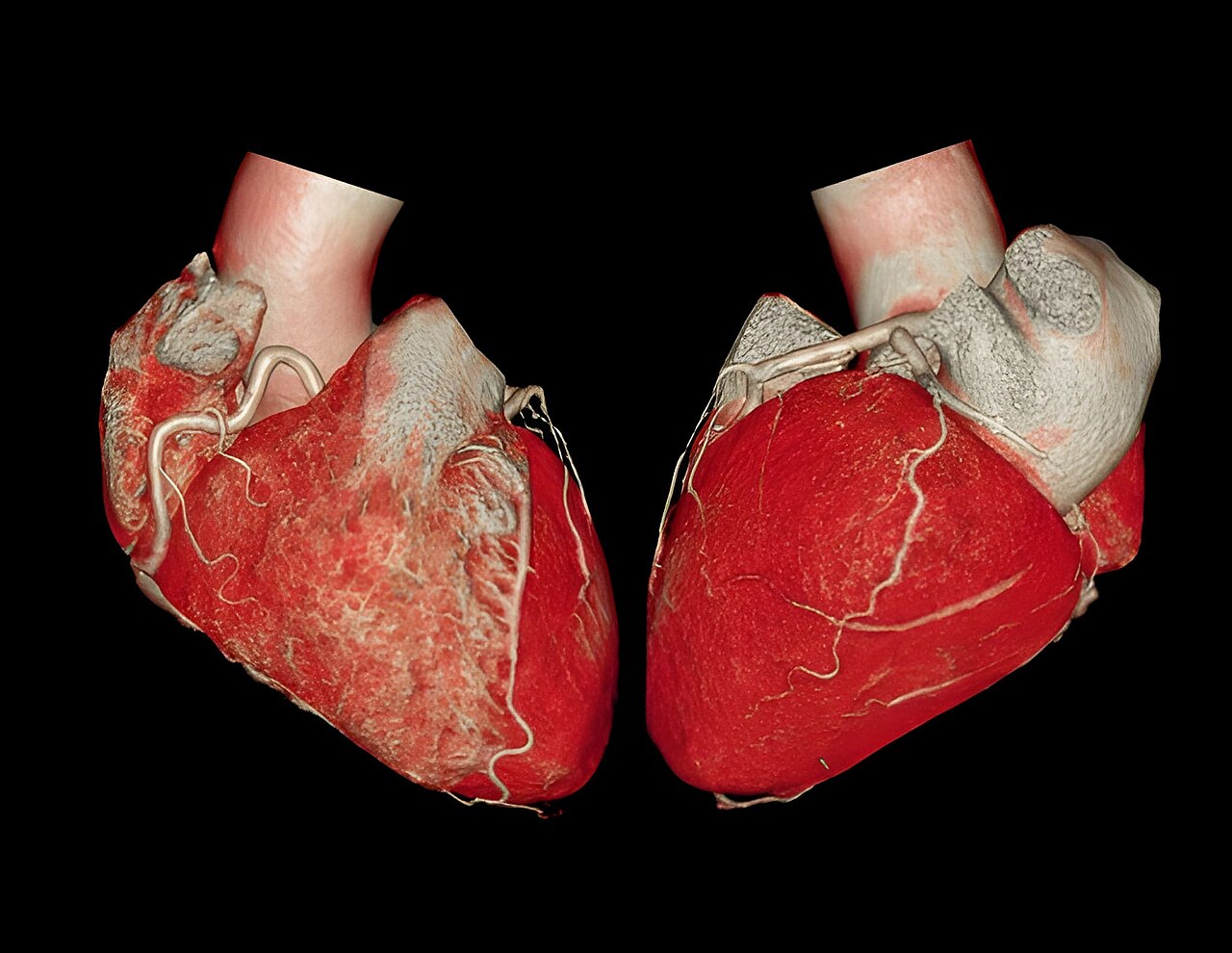 Coronary CT Angiography (CCTA) Explained (coronary ct angiography) — giography ccta explained illustration