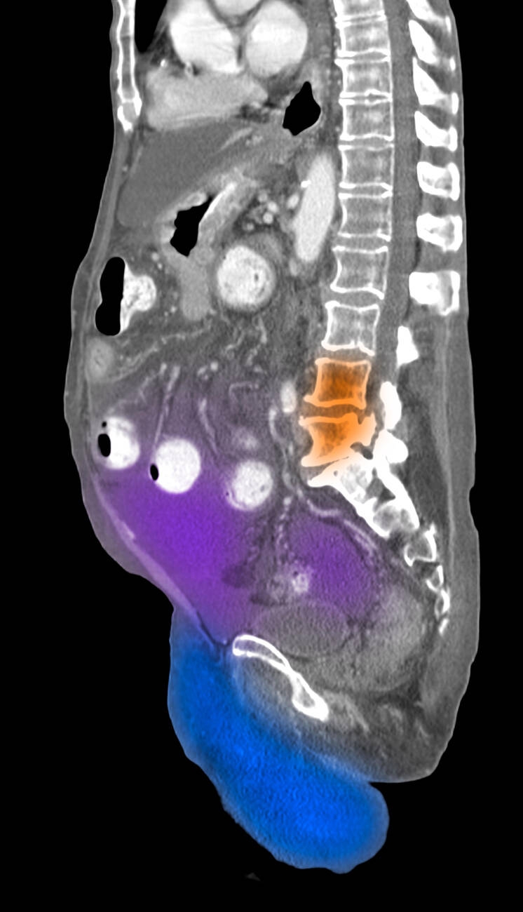 CT Abdomen and Pelvis Explained (ct abdomen pelvis scan) —  with contrast explained illustration