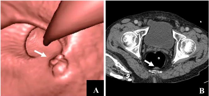 CT Colonography (Virtual Colonoscopy) Explained (ct colonography) — al colonoscopy explained illustration