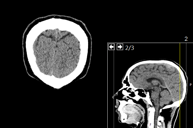 CT Head Scan Explained (ct head scan) — d stroke trauma headache illustration