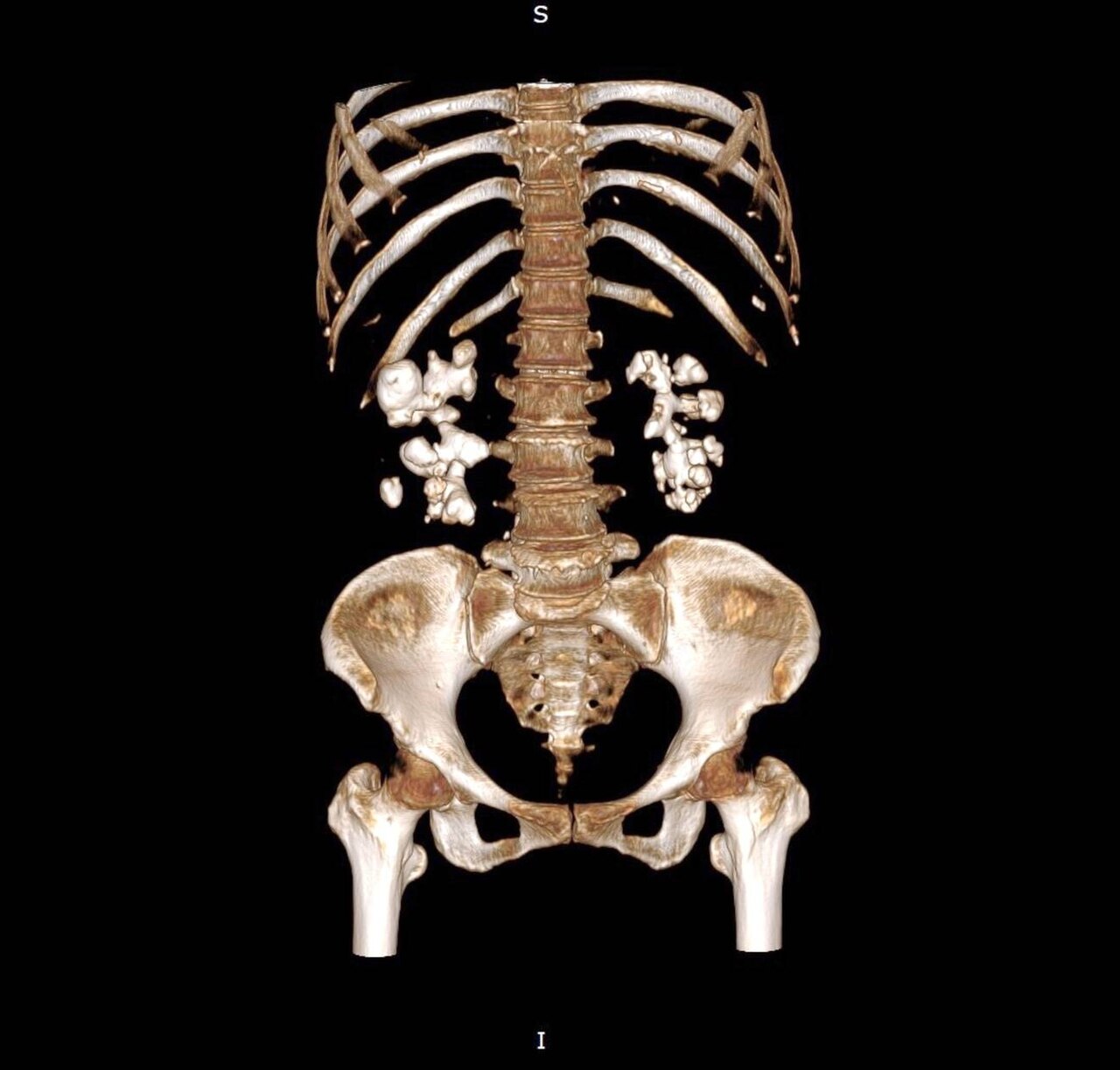 CT KUB Scan Explained (ct kub scan) —  explained kidney stones illustration