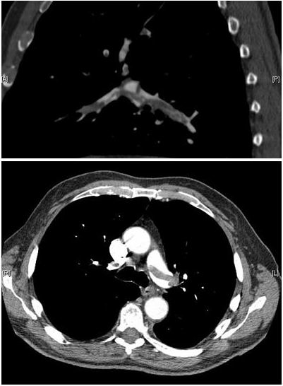 CTPA (CT Pulmonary Angiogram) Explained (ctpa scan) — nary angiogram explained illustration