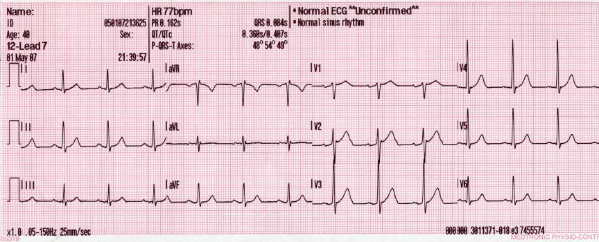12-Lead ECG Explained (12 lead ecg explained) — ctrocardiogram explained illustration