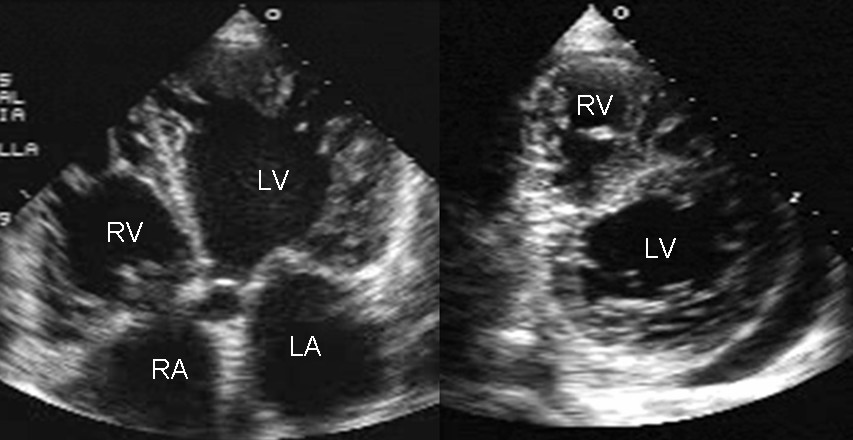 Echocardiogram Explained (echocardiogram explained) —  fraction heart function illustration