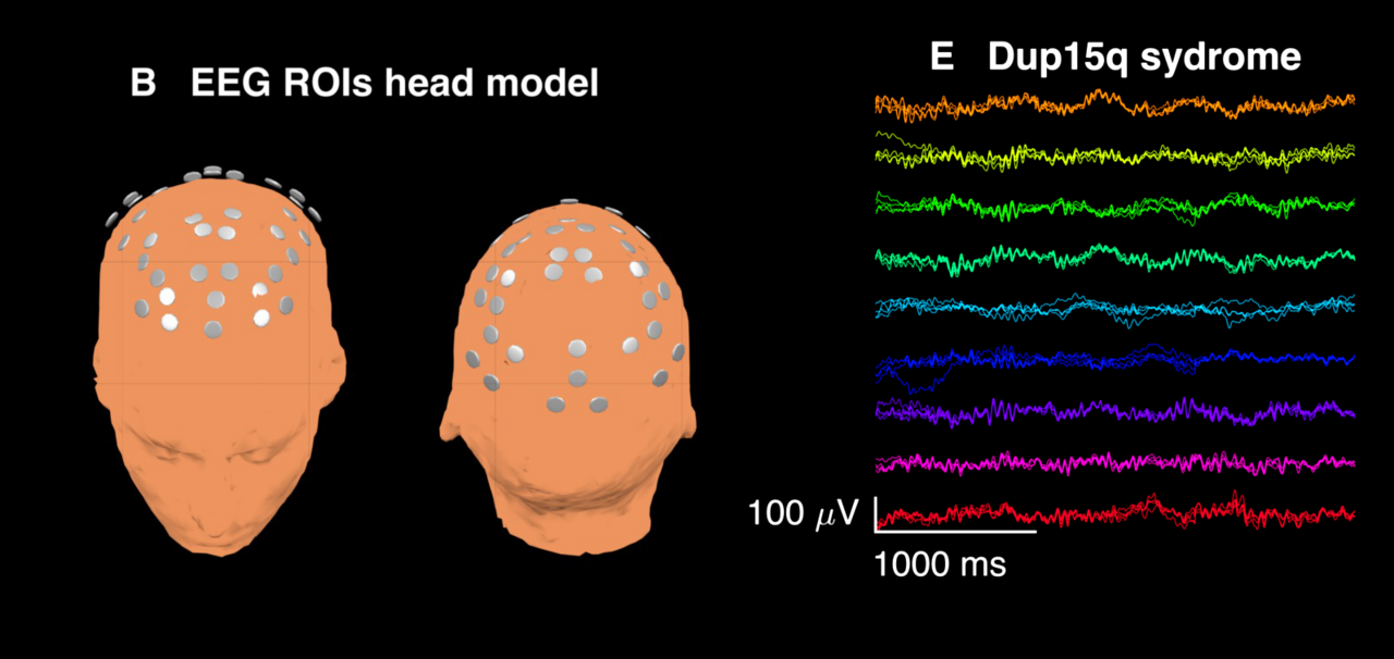 EEG (Electroencephalogram) Explained (eeg electroencephalogram) — ogram explained seizures illustration