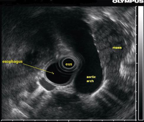 Endoscopic Ultrasound (EUS) Explained (endoscopic ultrasound) — ultrasound eus explained illustration