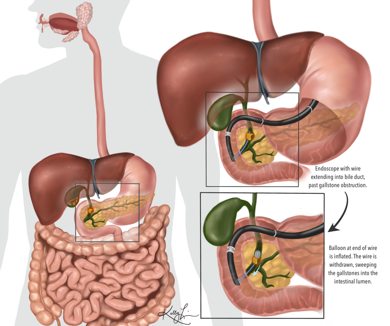 ERCP Explained (ercp procedure) — ancreatography explained illustration