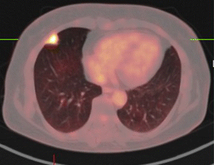 FDG PET-CT Explained (fdg pet ct scan) — plained oncology staging illustration