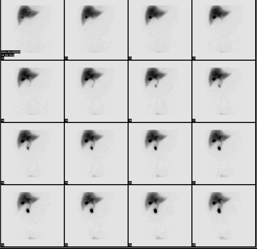 HIDA Scan Explained (hida scan) — y scintigraphy explained illustration