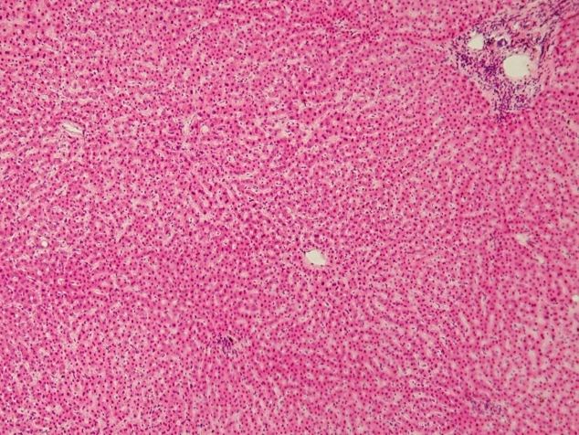 High ALT with Normal AST (high alt normal ast) — high alt normal ast illustration