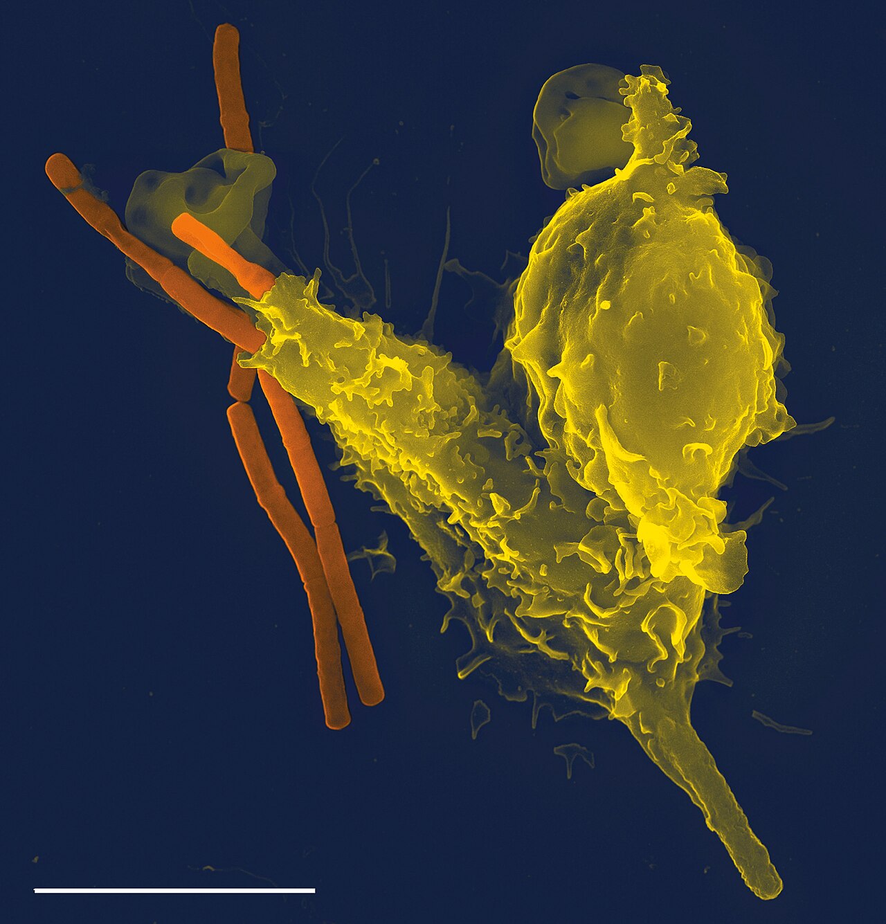 High White Blood Cells but No Infection (high wbc no infection) — high wbc no infection illustration