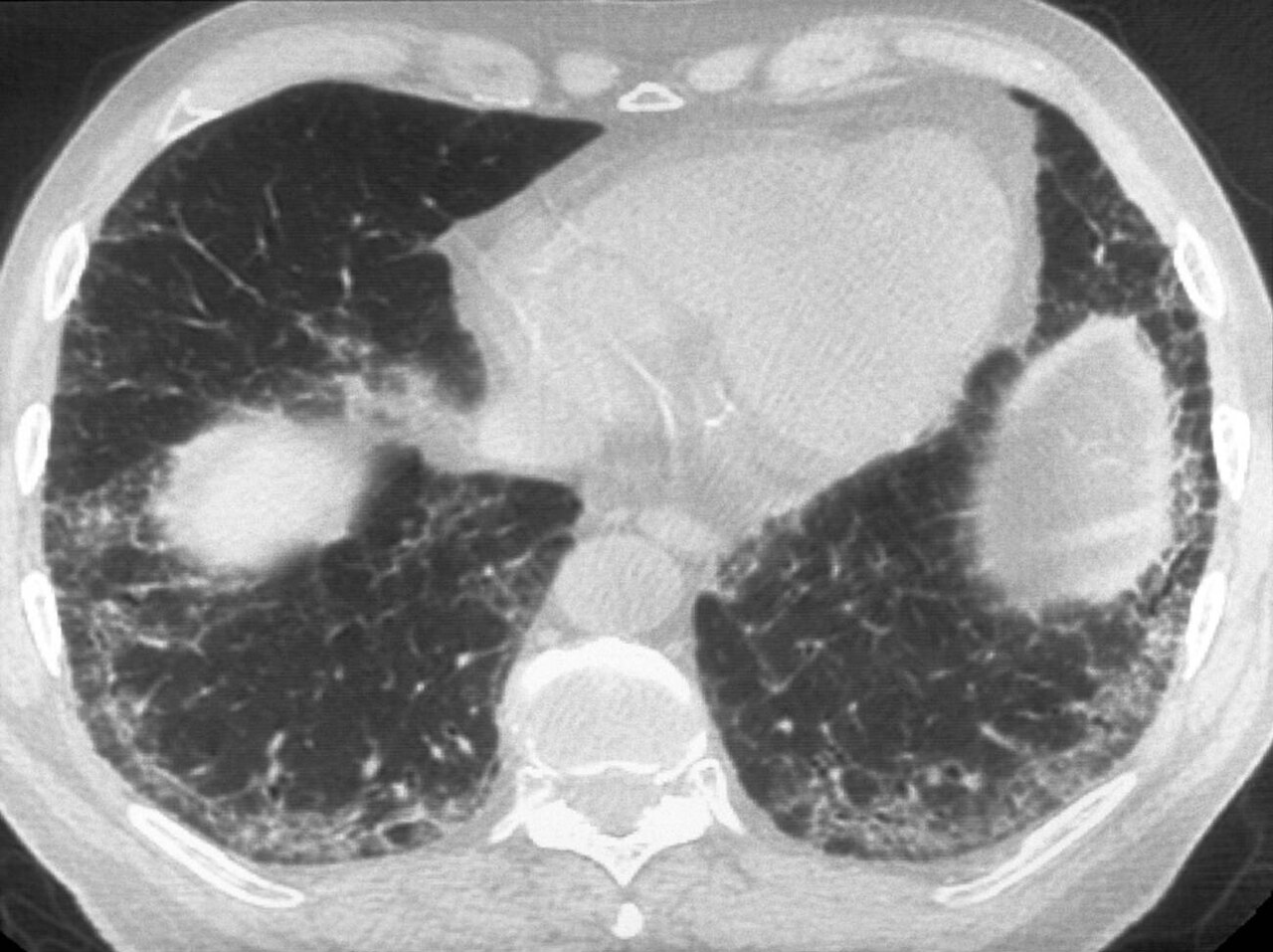 HRCT Chest Explained (hrct chest scan) — lution ct lung explained illustration