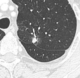 Low-Dose CT Lung Cancer Screening Explained (low dose ct lung cancer screening) — ncer screening explained illustration