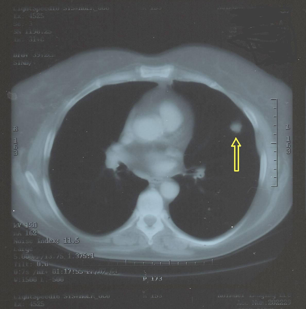 Lung Nodule Found on CT (lung nodule on ct scan) — lung nodule on ct scan illustration