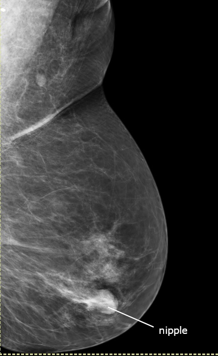 Mammogram Explained (mammogram explained) — reening explained birads illustration