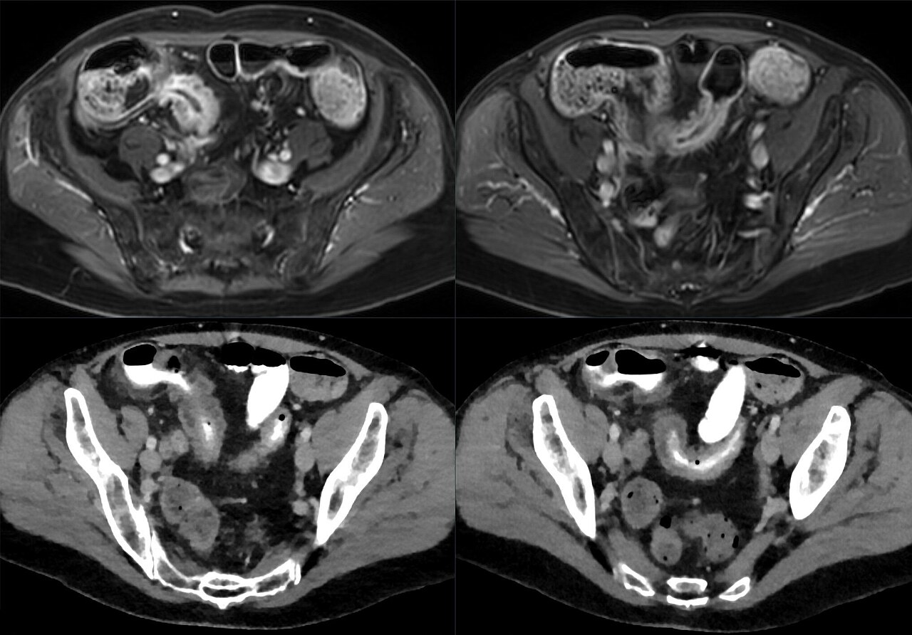 MR Enterography (MRE) Explained (mr enterography) — hn small bowel explained illustration