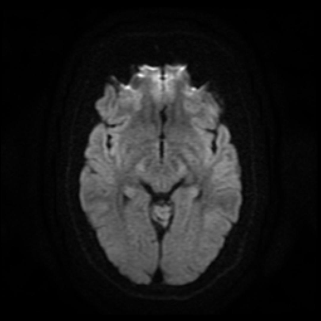 MRI Brain Explained (mri brain scan) — ained headache ms tumour illustration