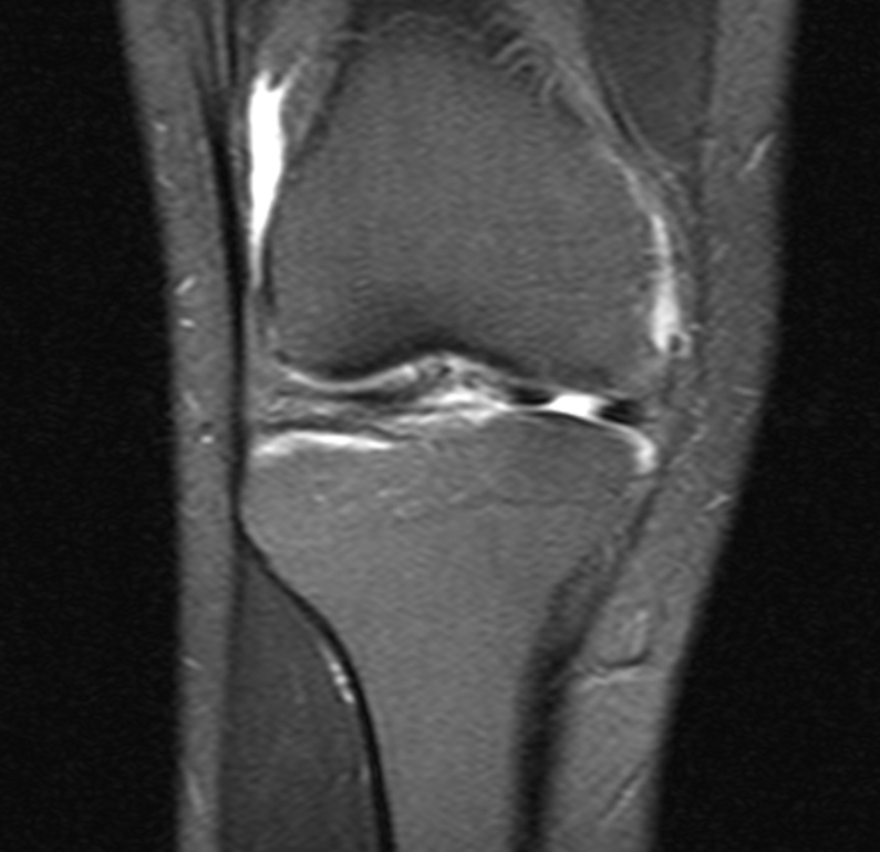 MRI Knee Explained (mri knee scan) — d meniscus acl cartilage illustration