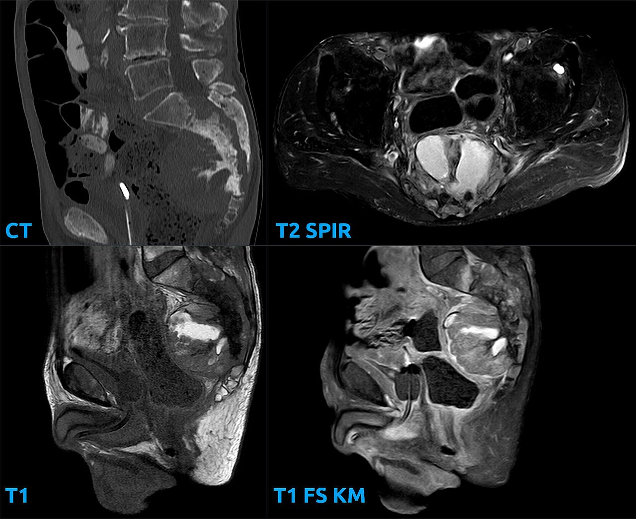 Multiparametric Prostate MRI (mpMRI) Explained (multiparametric prostate mri) — tate mri mpmri explained illustration