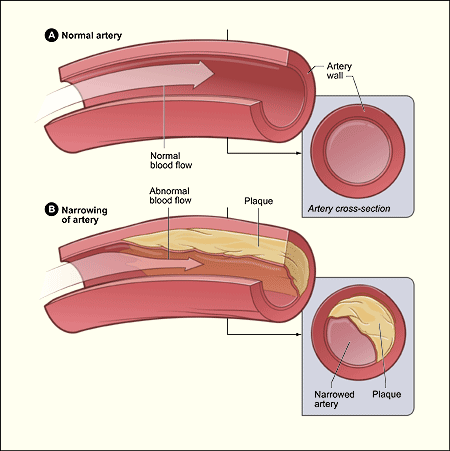 Non-HDL cholesterol and atherosclerosis
