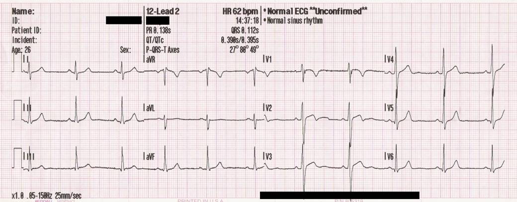 Normal ECG But Chest Pain (normal ecg but chest pain) — ormal ecg but chest pain illustration