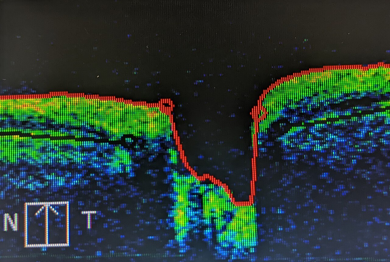 OCT Eye Scan Explained (oct eye scan) — nce tomography explained illustration