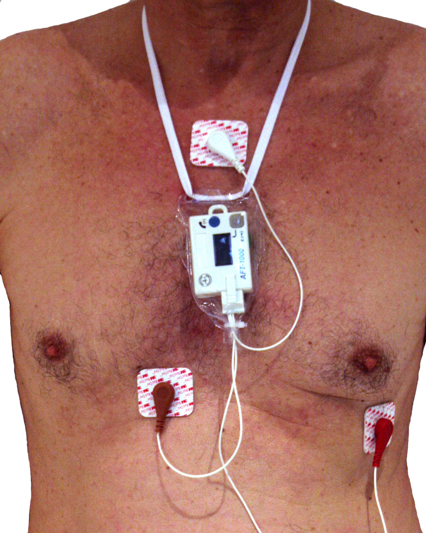 Palpitations With a Normal ECG (palpitations normal ecg) — palpitations normal ecg hero image