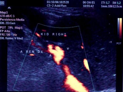 Renal Artery Doppler Ultrasound Explained (renal artery doppler) — ler ultrasound explained illustration