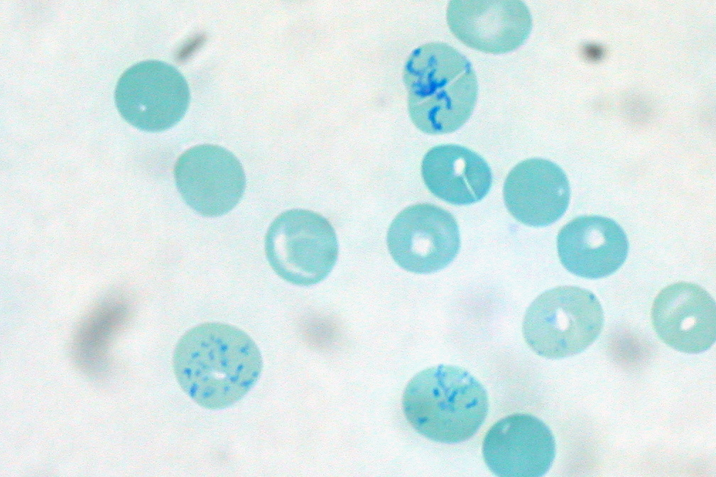 Reticulocyte Count (reticulocyte count normal range) — anaemia workup explained illustration
