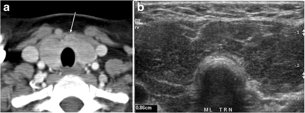 Thyroid gland anatomy with antibody test tube and lab report