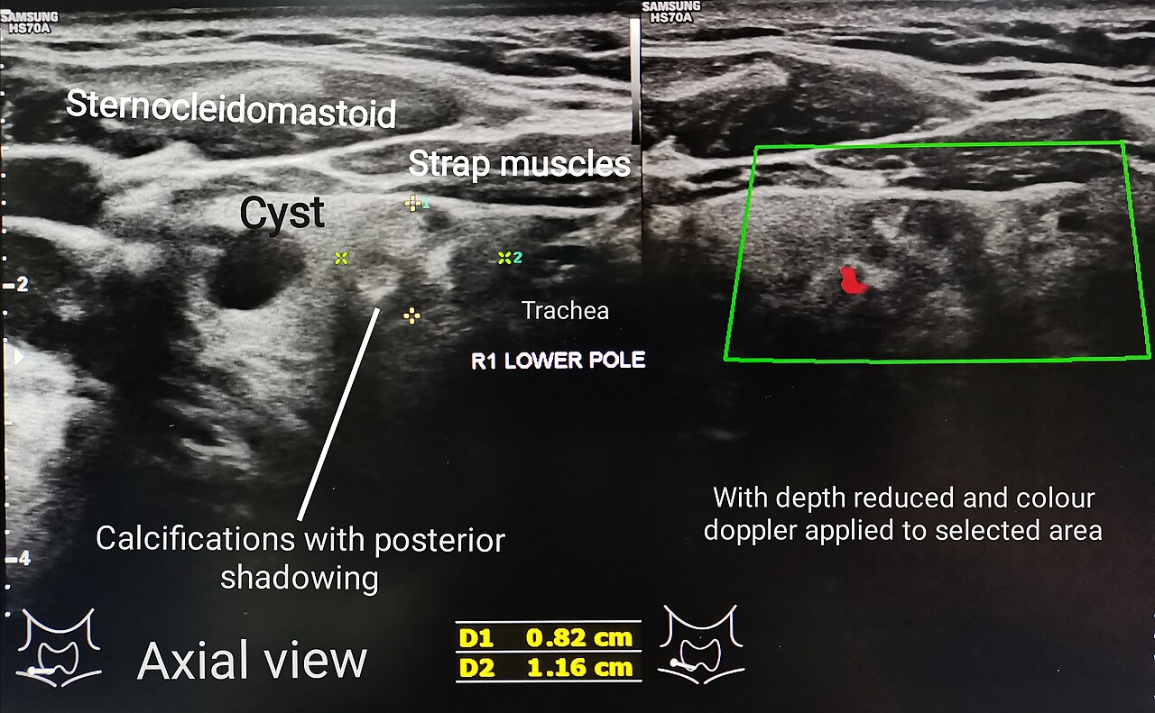 Thyroid Ultrasound Explained (thyroid ultrasound explained) — i rads nodules explained illustration