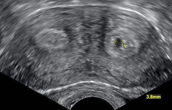 Transvaginal Ultrasound Explained (transvaginal ultrasound) — ly pregnancy pelvic pain illustration