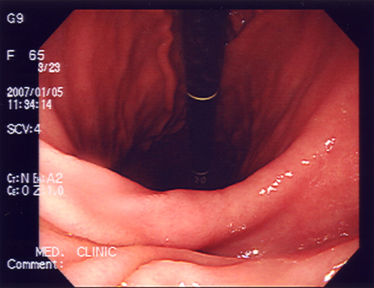 Upper GI Endoscopy (OGD) Explained (upper gi endoscopy) — ained dyspepsia barretts illustration