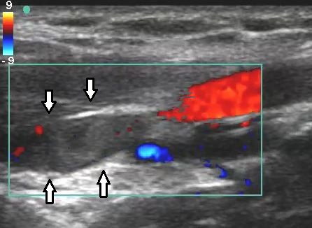 Venous Doppler Ultrasound Explained (venous doppler ultrasound) — ultrasound dvt explained illustration